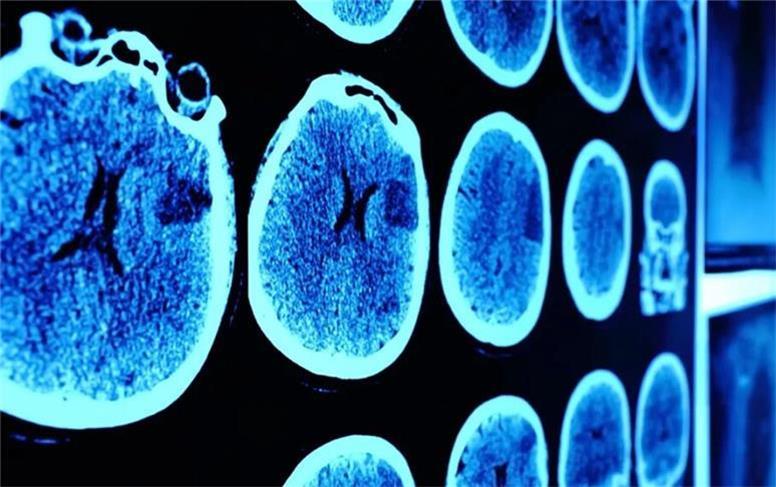 نجات پسر 13 ساله بلژیکی از تومور کشنده مغزی برای اولین بار در جهان