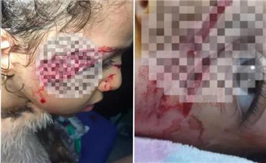 زخمی شدن دختربچه در حمله سگ ولگرد